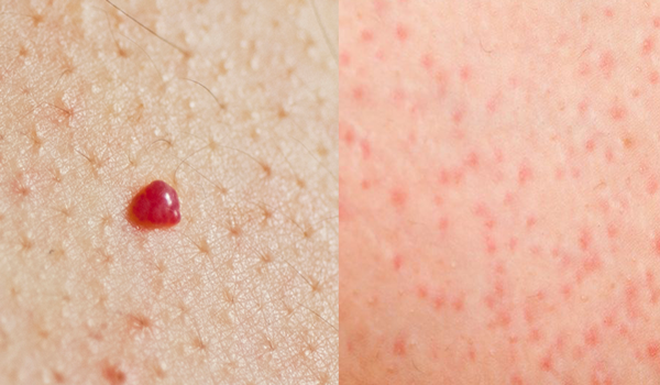 What Do The Red Moles On The Body Mean? - Healthy Food Advice