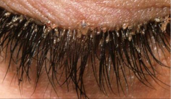 Yes You Do Have Mites In Your Eyelashes And Here Is What You Must Do Healthy Food Advice 